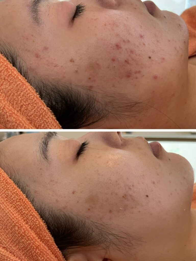 ニキビ改善サロンなら、愛知県一宮市の「home salon PURE」